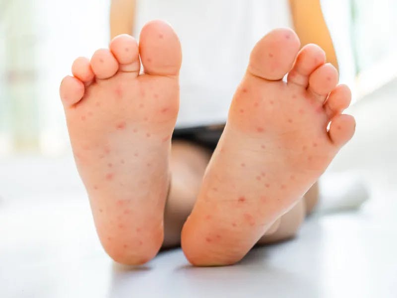 Höstblåsor på fötterna hos ett barn | Få behandling på ReceptOnline.se